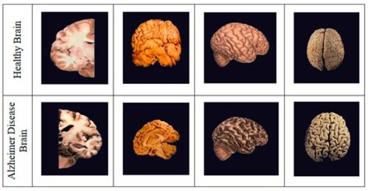 Cognitive assessment could help us detect Alzheimer’s earlier